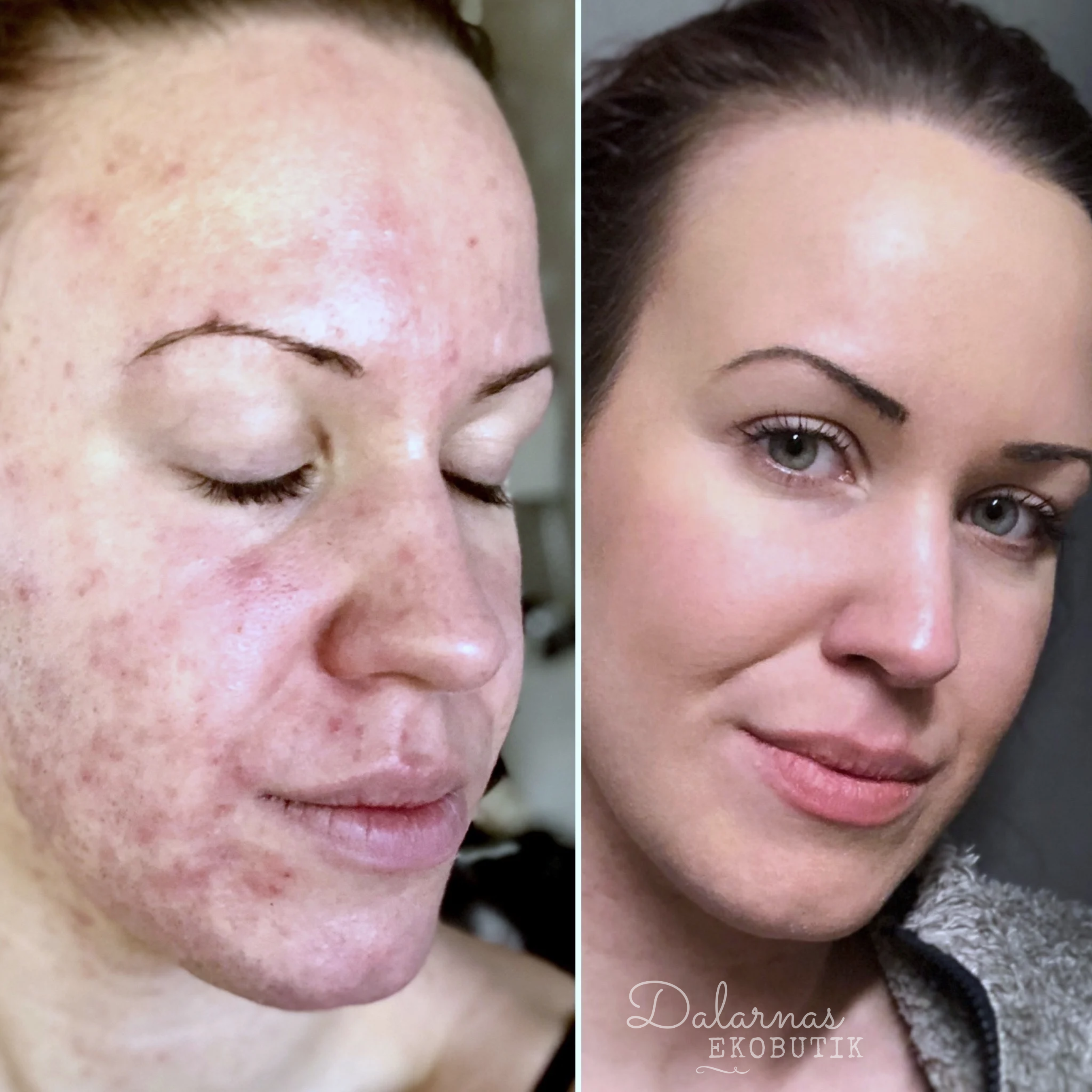 AHA Clean & Glow, ECO Facial Nattserum (tidigare Face Oil Acne Treatment) - Dalarnaseko.se